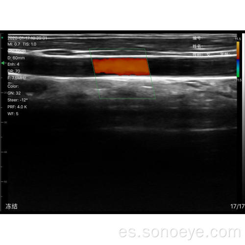 Tipo de sonda lineal súper ancho Mini ultrasonido inalámbrico